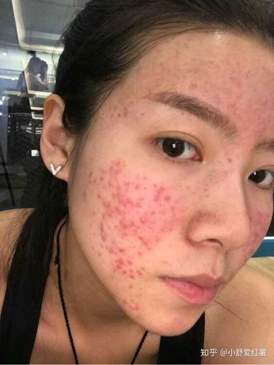 臉上的痘印應(yīng)該怎樣去除