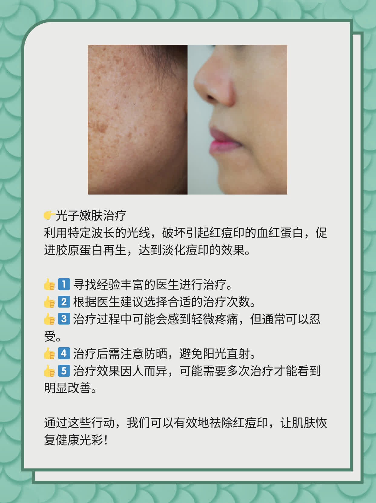 如何有效去除紅痘印，一站式解決方案，一站式解決紅痘印問題，有效去除方法大全