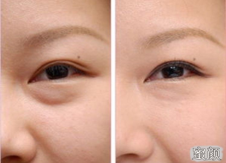 如何消除眼袋，簡單實用的方法，消除眼袋的實用方法與技巧
